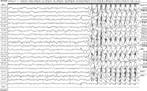 znam pojmu idiopatický musíme v epileptologii chápat ve smyslu jednotky sui generis, nikoliv onemocnění s neznámou etiologií.