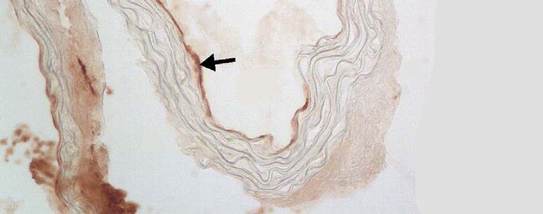 Obr. 1: Exprese VCAM-1 v endotelu aortálního sinu cholesterolové skupiny zvířat (A) a skupiny, které byl podáván atorvastatin (B).