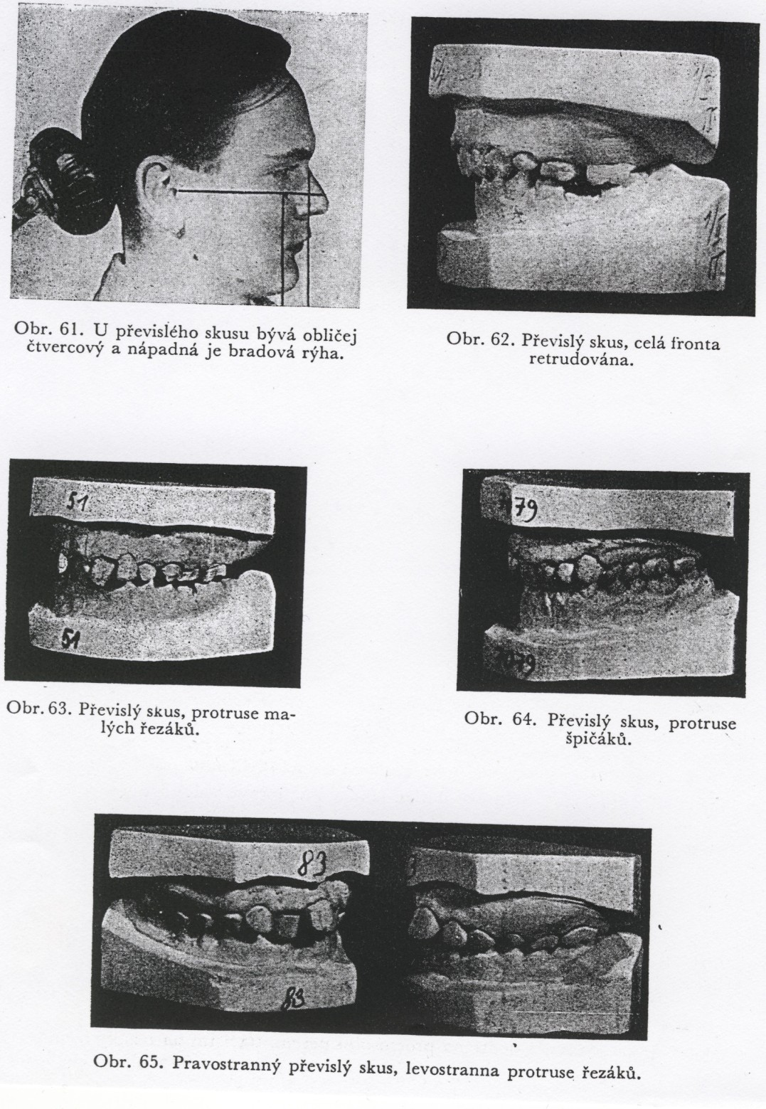 Převislý skus Je charakterizován velkou apikální bází horní čelisti a palatinálním sklonem horních řezáků a stoliček.