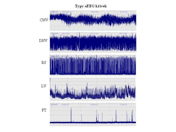 Obr. 6: Typy aeeg křivek CNV normální křivka s minimální amplitudou 7 10 µv a maximální 10 25 µv DNV mírně abnormální křivka s minimální amplitudou pod 5 µv a maximální