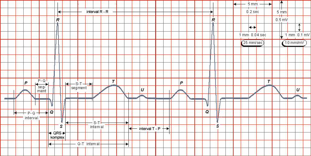 normální průběh dráždění čas [ms] EKG rychlost vedení [m/s] sinusový uzel tvorba podnětů 0 0,05 vlna P vstup impulsu pravá síň 50 0,8-1,0 v síni do vzdálených částí síní levá síň 85 AV-uzel úsek P-Q