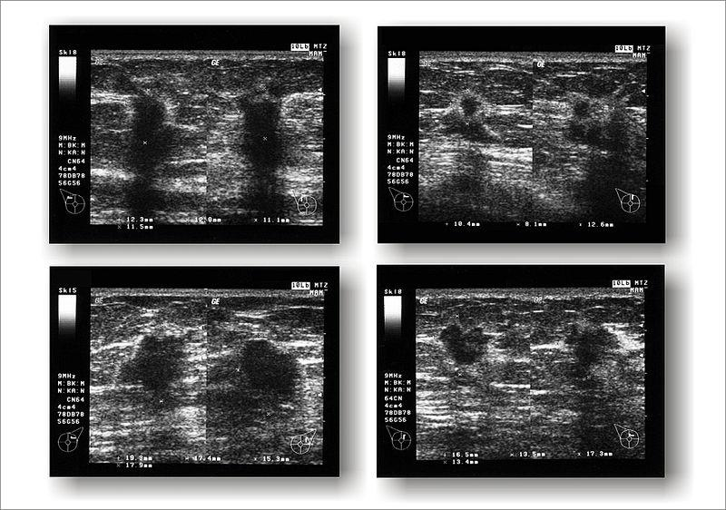 Obrázek 11 - Hic et nunc, Public domaine, (http://commons.wikimedia.org/wiki/file%3abreastcancer_ultrasound.jpg) 2. Řešený příklad (Hlavička, A. et al., 1978).