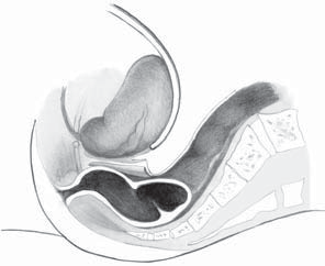 Anatomické poznámky 19 dem k tomu, že vývojově jde o zbytek slepého peritoneálního výběžku, lze sledovat u dennonvillierské fascie jednu vrstvu adherující k semenným váčkům a prostatě a druhou vrstvu