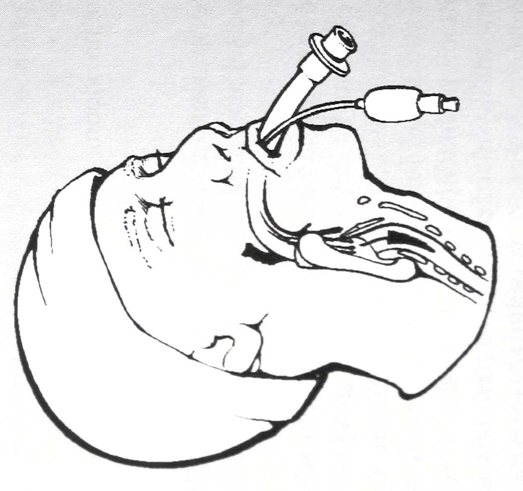 Příloha 12 Zavádění laryngeální masky a zavedená laryngeální maska