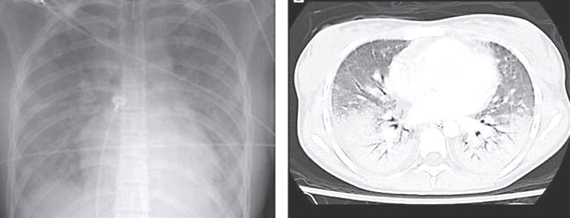 Těžká forma ARDS ( akutní hypoxemické respirační selhání) (P/F index < 150mm Hg, LIS Score > 2.