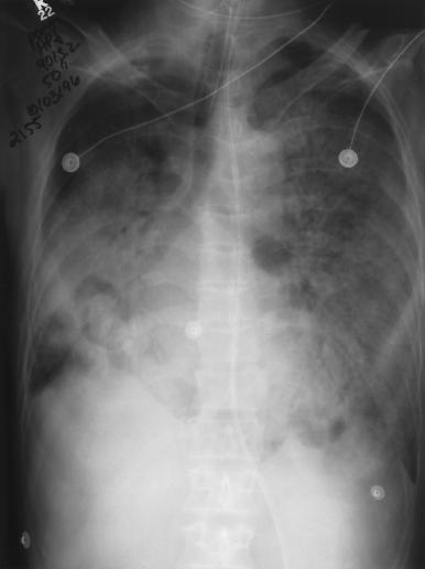 Chest radiograph with
