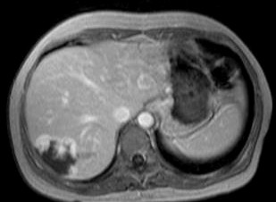 4: Vlevo CT postkontrastní obraz hemangiomu pravého laloku jater v portovenózní fázi. Vpravo MR obraz.
