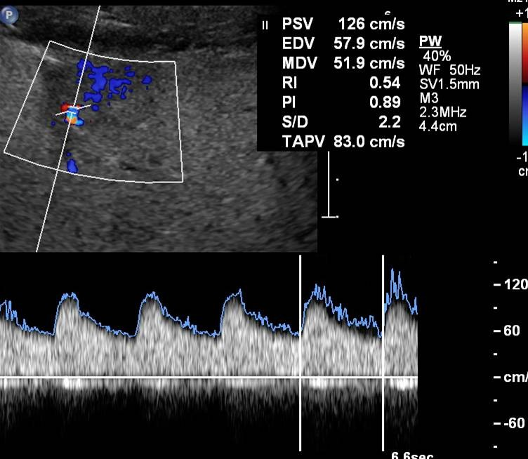 Obr. 6: Ultrazvukový obraz FNH hladce