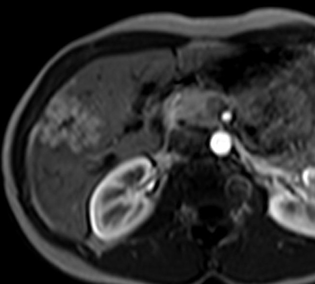 Obr. 8: MR vyšetření v arteriální (vlevo) a hepatospecifické fázi (vpravo) po podání orgánově specifické k.l. T1 váţený obraz, FNH je relativně hyperintenzní.