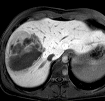 MR ukazuje periferní lem, heterogenitu a četné hyperintenzity. Tumor je většinou hyperintenzní v T1 i T2, protoţe obsahuje mnoţství hemoragií.