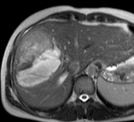 Tudíţ přestoţe mechanismus vstupu k.l. do hepatocytu jako takový bývá neporušen, chybí intracelulární transportní gradient a vázne tak aktivní transport přes sinusoidální membránu /2/. Obr.