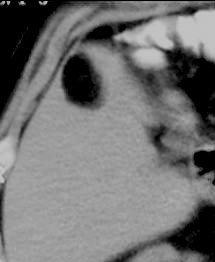 Ultrazvuk zobrazí hyperechogenní loţisko, které se můţe podobat hemangiomu, můţe být ale i nehomogenní.