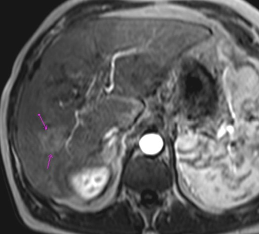 Obr. 16: HCC na terénu cirhosy: v pravém jaterním laloku, v arteriální fázi (vlevo) je sledovatelné výraznější