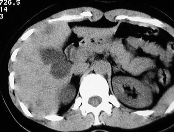 Často ji vidíme ve third inflow oblastech sníţený portální průtok zde vede k nutriční ischémii hepatocytu a ke vzniku tukových depozit ( hepatocyte balooning ). Je nutno dávat pozor na event.