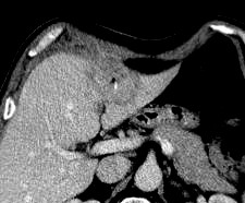 Obr. 29: V CT obraze je v arteriální fázi po aplikaci k.l. patrné výrazné sycení levého laloku (hyperémie), v portovenózní fázi je zřetelné oválné hypodenzní loţisko s centrální hyperdenzitou a bublinou plynu.