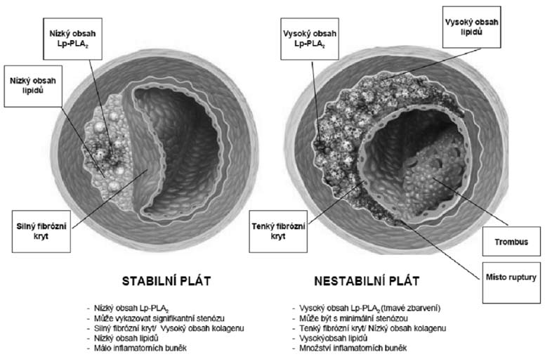 16. Lipoprotein-associated phospholipase A2 and risk of coronary disease, stroke,