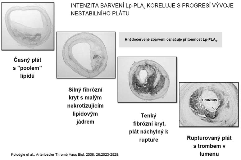 Lancet 2010; 375: 1536 44. PLAC je registrovanou známkou diadexus, Inc. Obrázek č. 1. Stabilní a nestabilní plát Obrázek č.