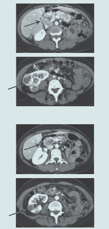 21. červen 2005 17. říjen 2005 TARGET: Treatment Approaches in Renal Cancer Global Evaluation Trial (schéma uveřejněno s laskavým svolením B. Escudiera). Schéma 3.