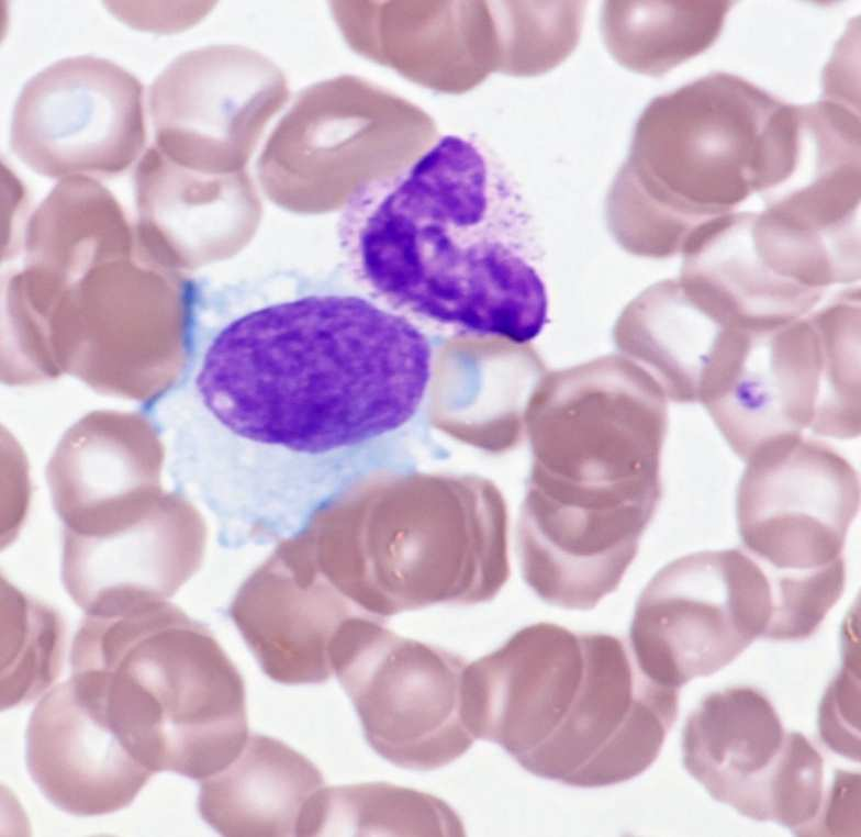 1.3 Nátěr periferní krve U většiny nemocných nacházíme v nátěru periferní krve leukemické (vlasaté) buňky.