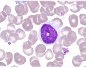Obrázek č. 4: Vlasatobuněčná leukémie zvětšení 1000x Vlasatá buňka s prstenčitým tvarem jádra, roztřepenou světle bazofilní cytoplazmou. 1.4 Vyšetření kostní dřeně Aspirace kostní dřeně (KD) bývá obtížná z důvodu fibrózy.