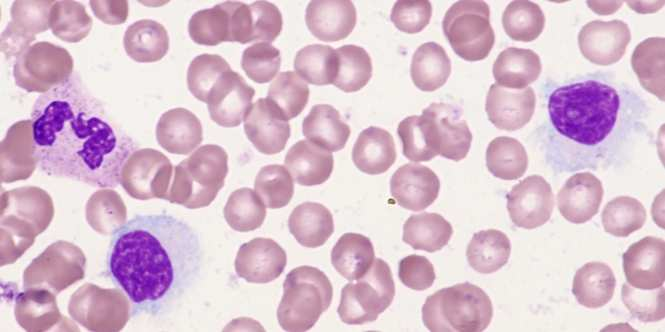 1.7 Variantní forma vlasatobuněčné leukemie Variantní forma vlasatobuněčné leukemie je onemocnění charakterizováno splenomegalií, mírnou anémií, trombocytopenií a poměrně výraznou leukocytózou