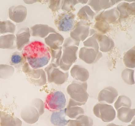 Obrázek č. 8: Barvení na přítomnost kyselé fosfatázy - aspirát kostní dřeně, zvětšení 1000x Leukemické elementy jsou buňky s růžovou cytoplazmou.