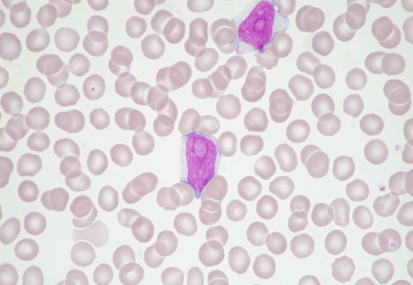3.2 Prolymfocytární leukémie Prolymfocytární leukémie je charakterizována výraznou splenomegalií a leukocytózou.