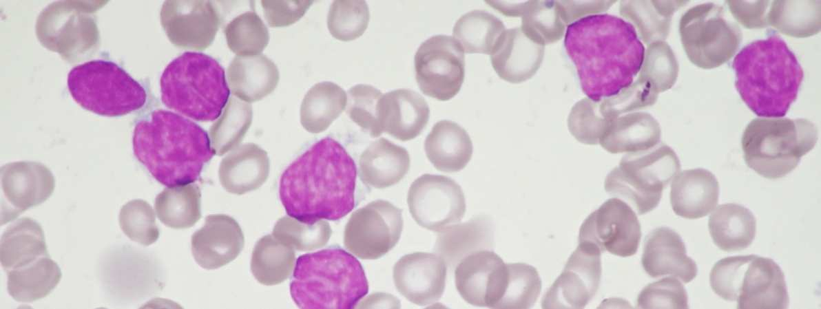 3.3 Lymfom z plášťových buněk U lymfomu z plášťových buněk jsou pozorovány leukemické buňky s vysokým poměrem N/C, světlou cytoplazmou, s