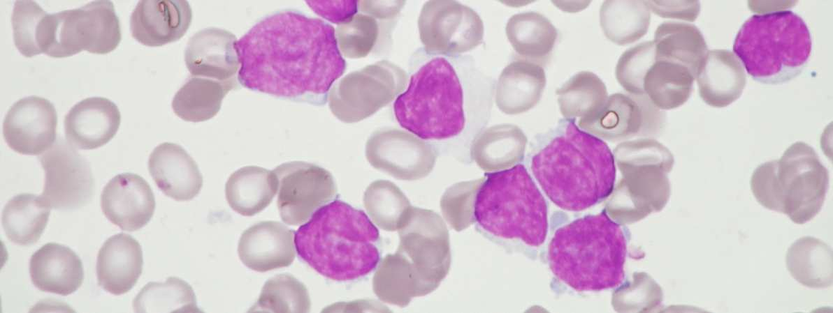 12: Lymfom z plášťových buněk nátěr periferní krve, zvětšení 1000x Na obrázku jsou leukemické buňky s nepravidelným tvarem jádra, vysokým