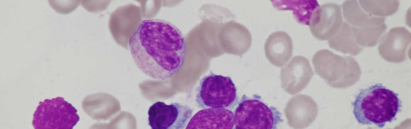 3.5 Lymfoplazmocytární lymfom U lymfoplazmocytárního lymfomu bývá v periferní krvi lymfocytóza, nacházíme zde atypické lymfocyty, plazmocyty a plazmocytoidní