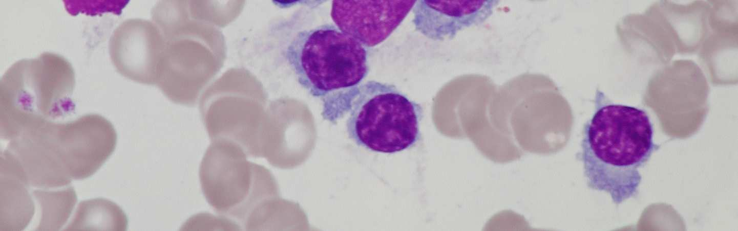 Plazmocytoidní lymfocyty jsou buňky s excentricky uloženým jádrem, hrubším jaderným chromatinem a objemnou bazofilní cytoplasmou.