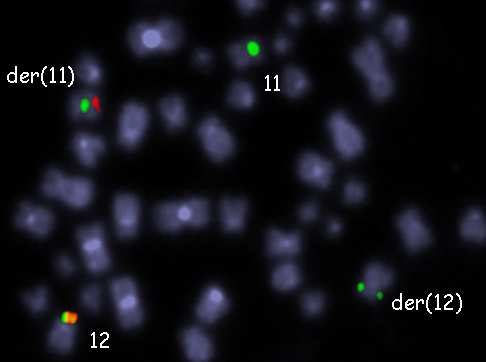 11 der(12) ToTel 12p der(11) der(12) mband 12: Identifikace zlomového místa p13 na chromozomu 12 a