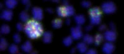 KLON 2. FISH s LSI MLL: Amplifikace MLL genu, kruhový chromozom 11.