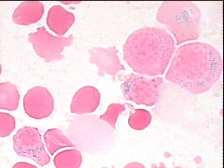 thrombocytosis 1.