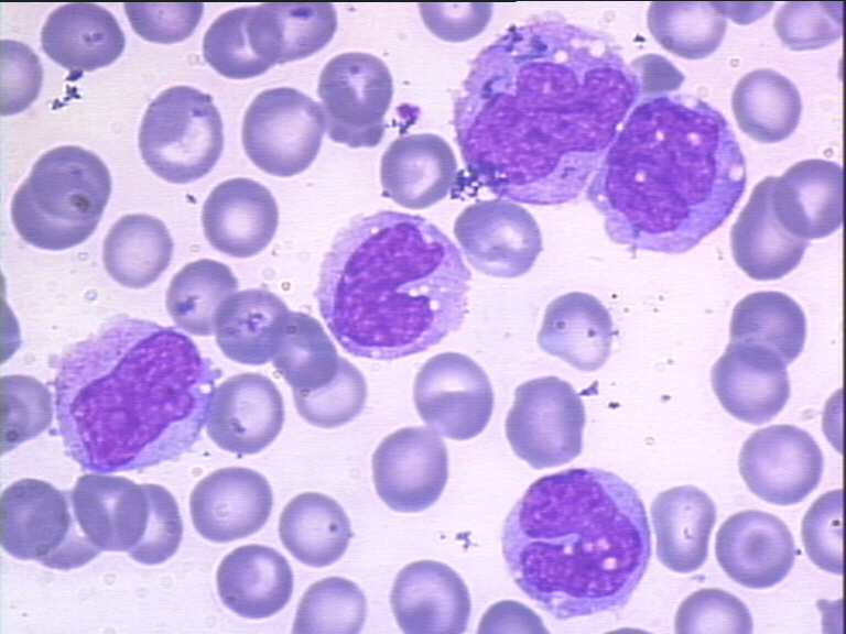 Monocyte: large cell with irregular cell outline large irregular often lobulated nucleus spongy lightly staining chromatin with a fairly