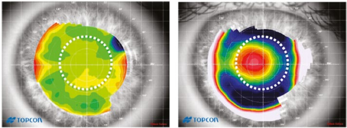 Tento rozdíl může být způsobený individuální velikostí sférické aberace jejich očí.