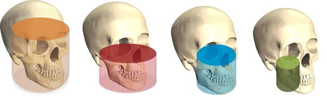 3.4.4 Cone Beam CT (CBCT) V současnosti nejvíc využívanou CT metodou ve stomatologii je Cone Beam CT (CBCT).