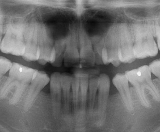 CBCT je tedy indikováno vždy u případů rozsáhlé resorpce, kde potřebujeme zjistit, zda resorpce zasahuje dřeň, kvůli rozhodnutí o ponechání či extrakci poškozeného zubu.