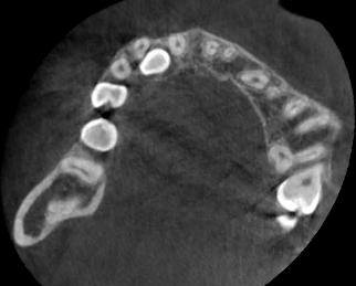 MPR je vhodné pro hodnocení vztahů kořenů zubů a je důležité pro diagnostiku resorpcí laterálních řezáků při retenci špičáků.