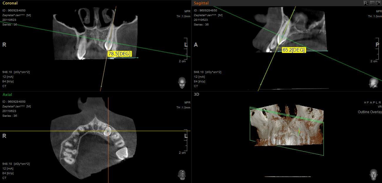 Obr. č. II/8: Sklon (inklinace) dlouhé osy špičáku od okluzní roviny na CBCT.