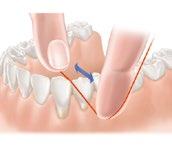 Zubní kartáček a zubní pasta přitom mohou vyčistit pouze žvýkací a boční plochy zubů. Do mezizubních prostor nedosáhnou.