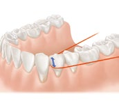 Podle postavení zubů a velikosti mezizubních prostor se k čištění používají zubní nit a mezizubní kartáčky.