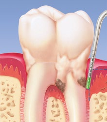 závažný úbytek kosti Zánět parodontu (parodontitida) Dáseň je zarudlá a oteklá,