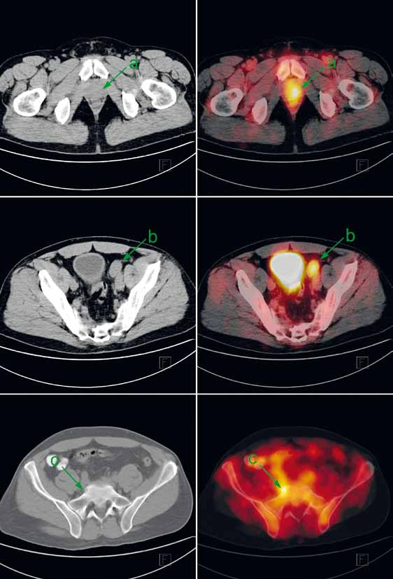 strana 208 Obr. 1. Pacient s biopticky ověřeným anaplastickým karcinomem prostaty byl v rámci iniciálního stagingu indikován k FDG-PET/CT.