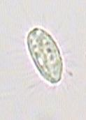 Glaucoma, Paramecium,