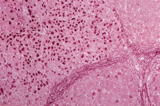 Obrázek č. 4 Chronická hepatitida B ve stádiu cirhózy. Preparát je barven orceinem. (Horák J.