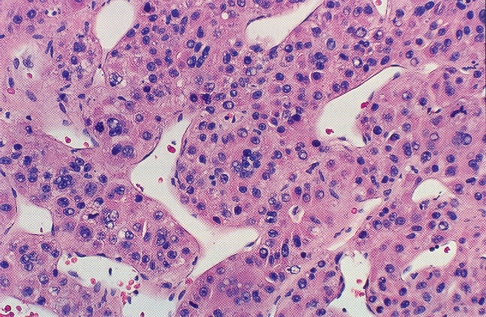 5 Histologický obraz vysoce diferencovaného hepatocelulárního karcinomu v terénu jaterní