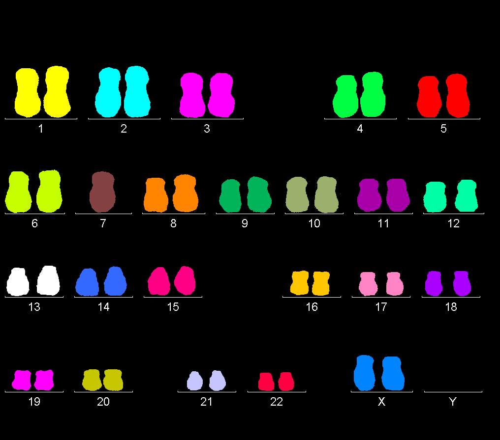 Obr. 14 mfish, karyotyp: 45,XX,-7 (obrázek získán z