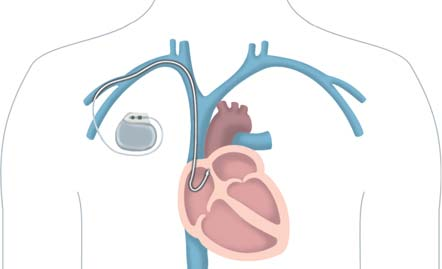 Podle typu Vašeho onemocnění Vám lékař vybere optimální kardiostimulátor. Existují dva typy stimulátorů jednodutinový a dvoudutinový.