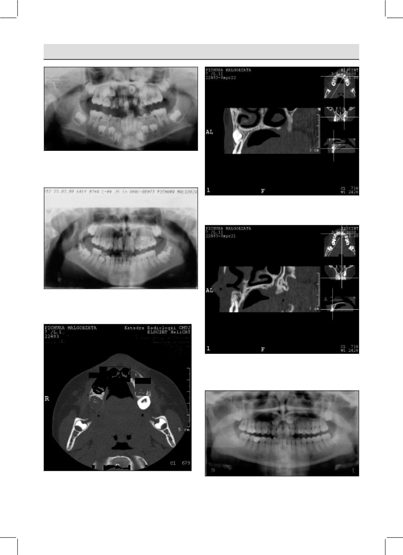 ročník 10 č. 3. 2001 Odborná práce ORTODONCIE Obr. 4A. Ortopantomogram zhotovený ve věku 9 let zobrazuje retenci zubu 21. Fig. 4A. Orthopantomograph performed at the age ofnine shows the retention oftooth 21.